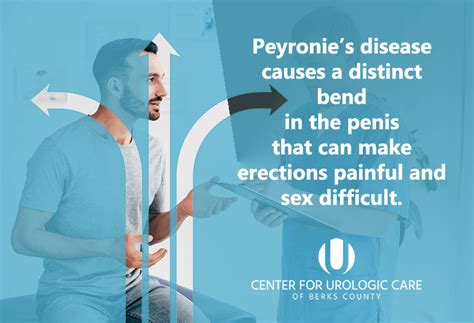 fucking sex|Peyronie disease